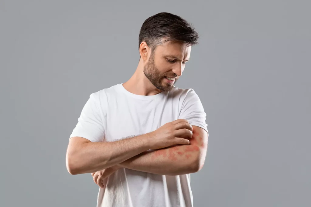 Psoriasis
