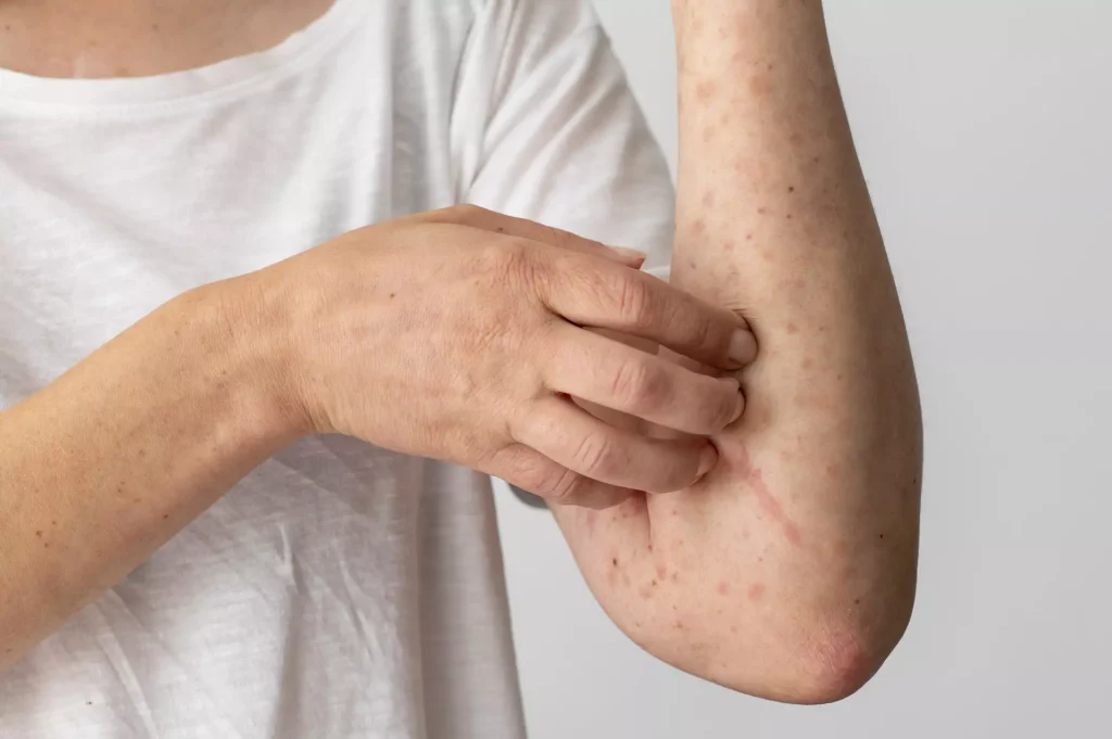 Dermatitis & Rashes